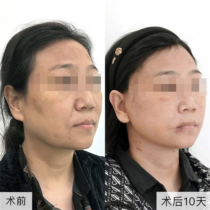 5Nasolabial fold improvement results