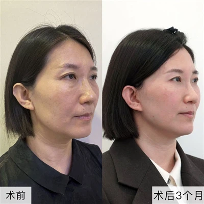 Näokirurgia põhimõtete põhjalik analüüs: miks näivad mõned inimesed pärast op...